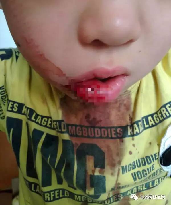 7岁孩子在马驹桥被逆行骑车人撞伤,嘴缝了10余针!家长