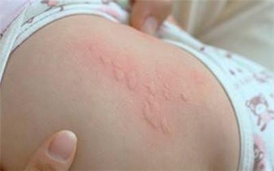 原来很多宝妈都做错了!10种婴儿皮疹
