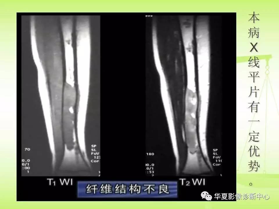 骨关节骨肿瘤及肿瘤样病变的mri诊断