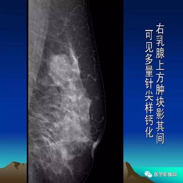 乳腺癌的钼靶诊断丨影像天地