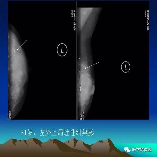 乳腺癌的钼靶诊断丨影像天地