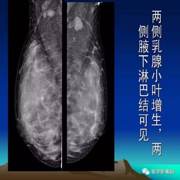 乳腺癌的钼靶诊断丨影像天地