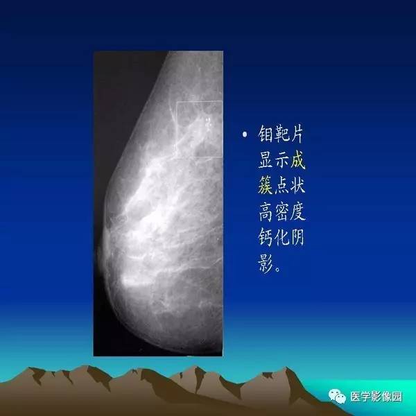 乳腺癌的钼靶诊断丨影像天地