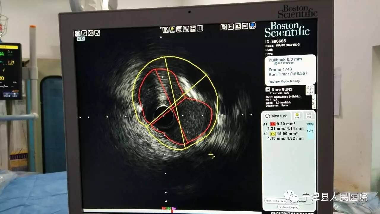 【新技术】宁津县人民医院成功开展血管内超声引导下冠状动脉介入治疗