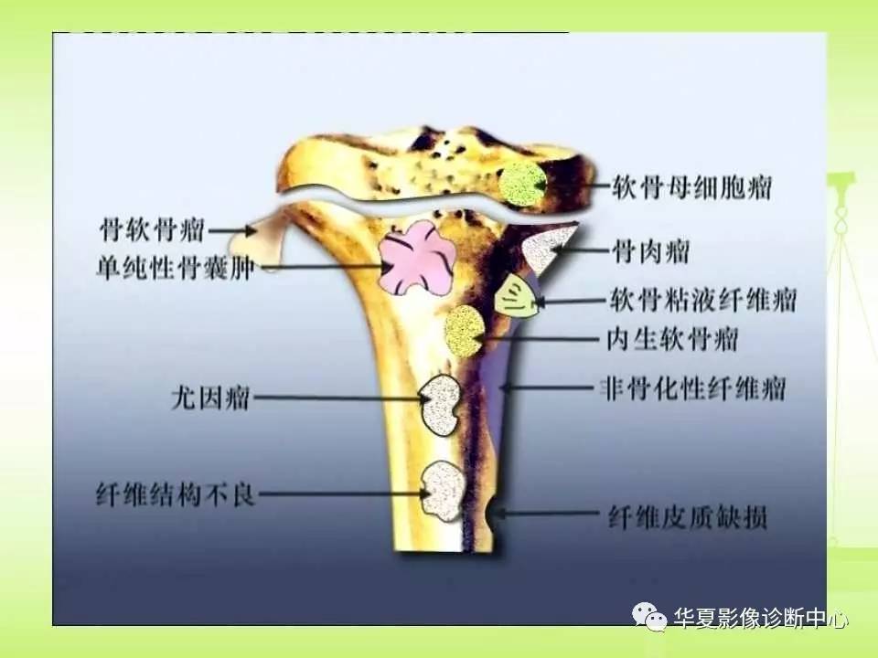 骨关节骨肿瘤及肿瘤样病变的mri诊断