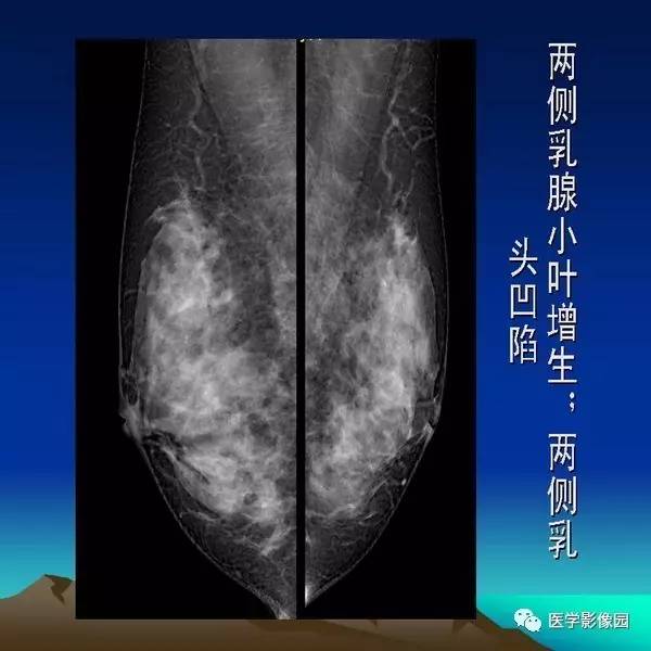 乳腺癌的钼靶诊断丨影像天地