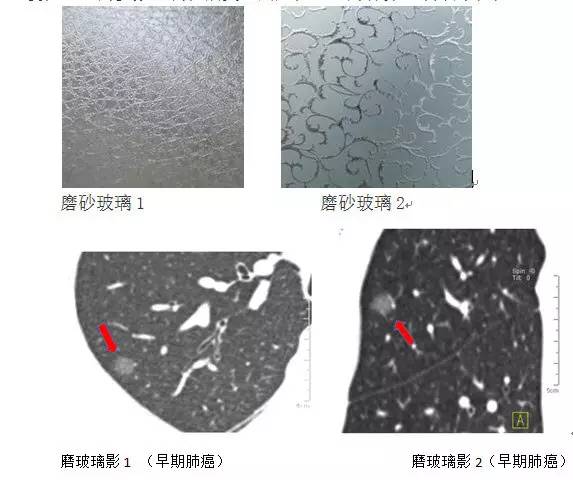 肺部毛玻璃样变≠肺癌,一文解析你不知道的 ggo