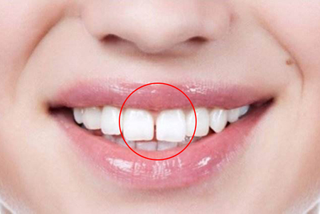 很多人的牙齿都会存在一定的问题,在面相学上就称之为"破绽",比如牙齿