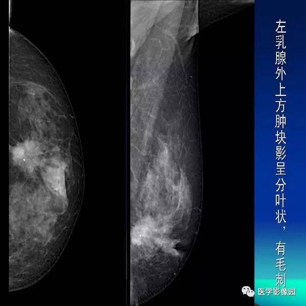 乳腺癌的钼靶诊断丨影像天地