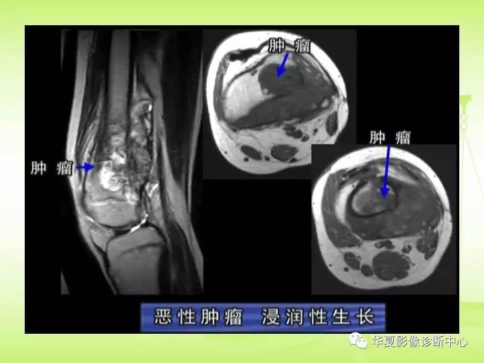 骨关节骨肿瘤及肿瘤样病变的mri诊断