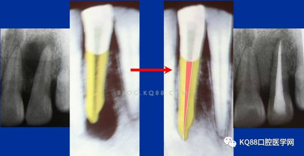根管治疗成功的保障