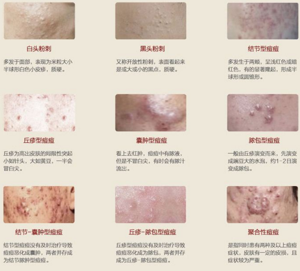炎性痘痘 (1)丘疹型痤疮:是青春痘最基本的一种,在毛囊被角质细胞
