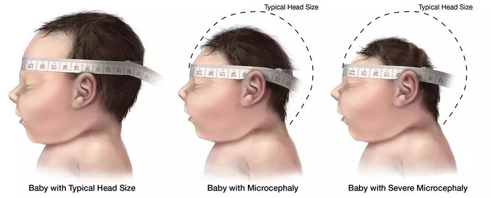 严重的小头症是一种更严重的极端形式,婴儿的头围远小于预期.