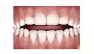 表现为双侧脸型不对称 表现为牙齿拥挤错位排列不齐 表现为上下牙齿不