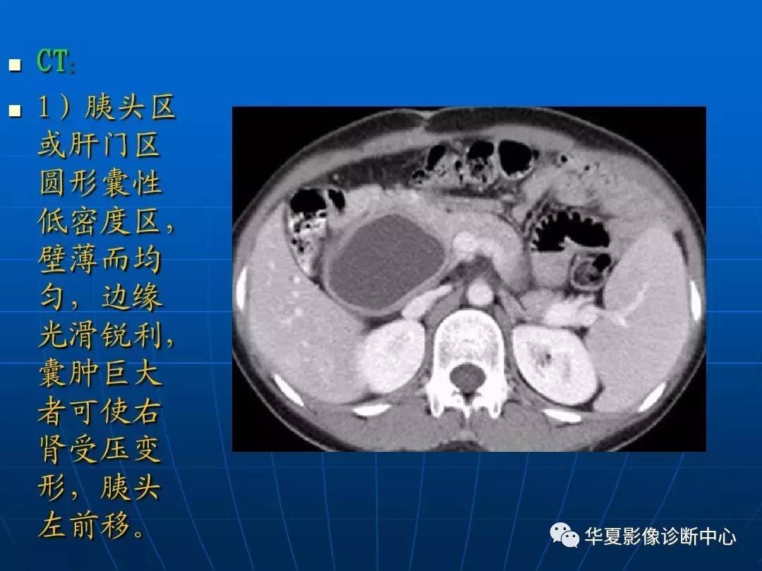 先天性胆管囊肿,该怎么分型?