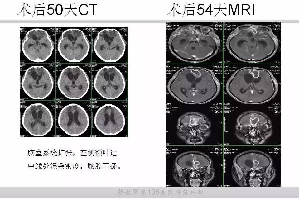 重型开放性颅脑损伤致脑脓肿一例丨颅脑创伤-神经重症病例周刊(第28期