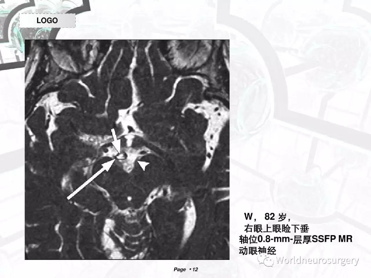 磁共振下的12对颅神经