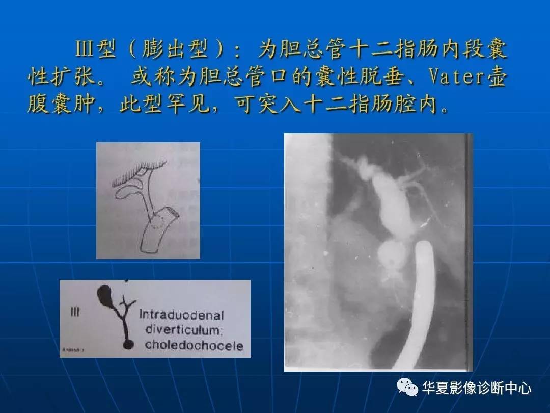 先天性胆管囊肿,该怎么分型?