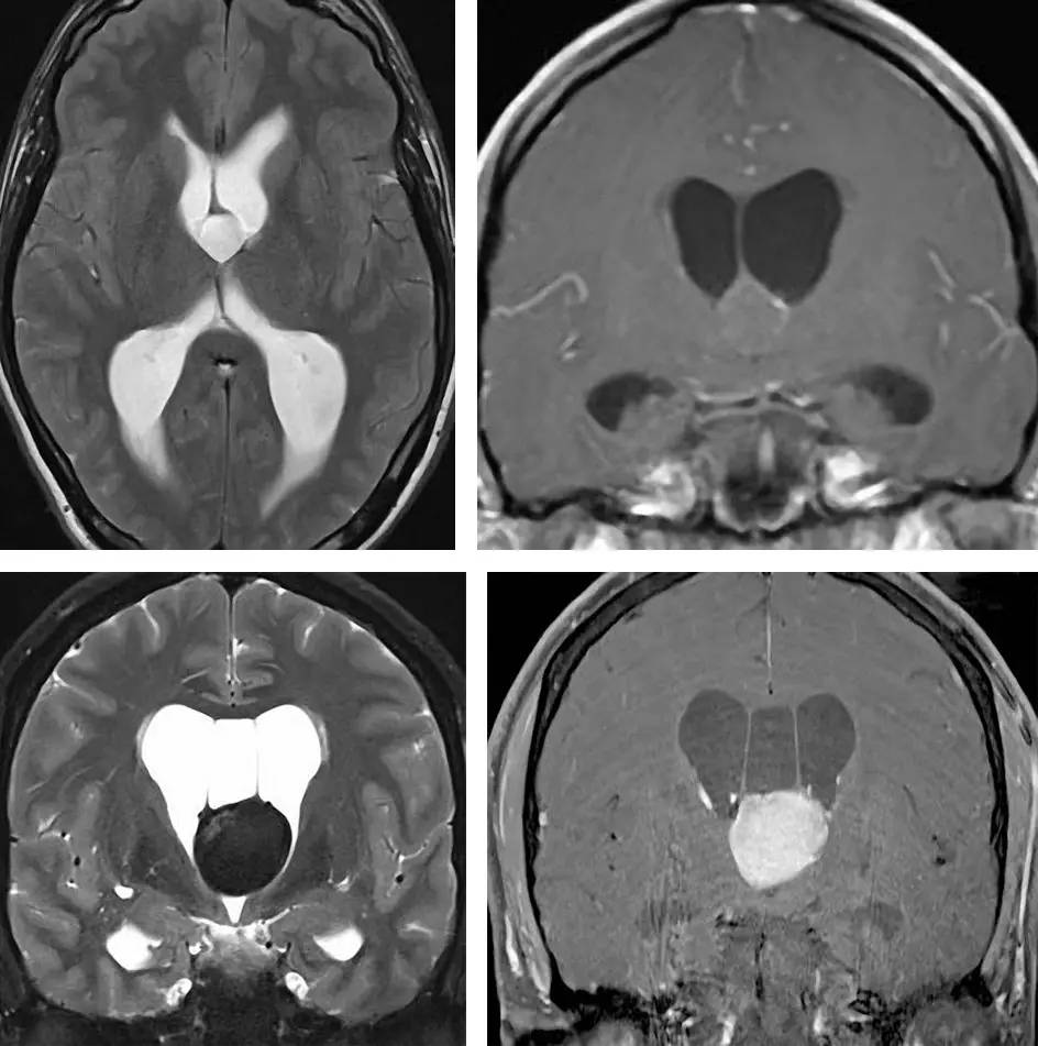 经胼胝体入路胶样囊肿切除技巧 the neurosurgical atlas全文翻译