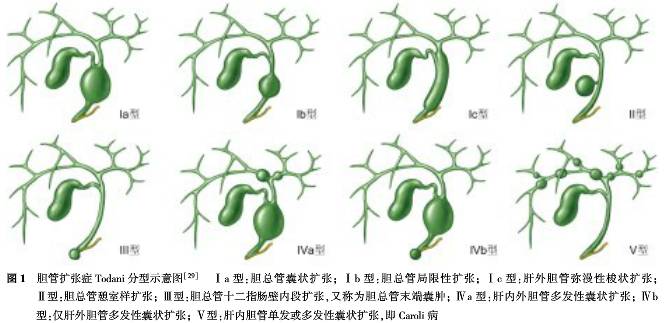 健康 正文 i型为胆总管扩张(最常见,占bd的70%～90%),分为3个亚型:ia