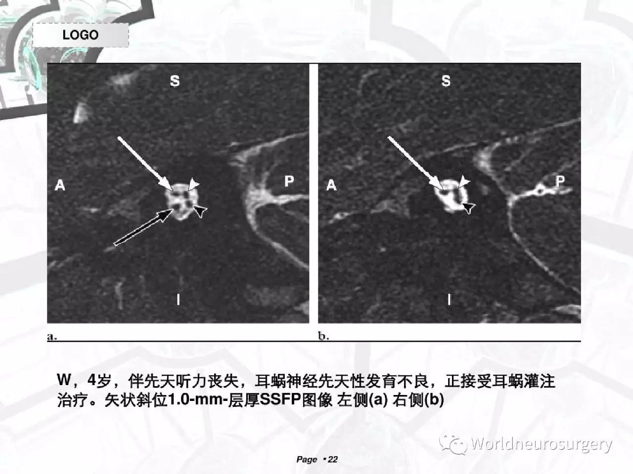 磁共振下的12对颅神经