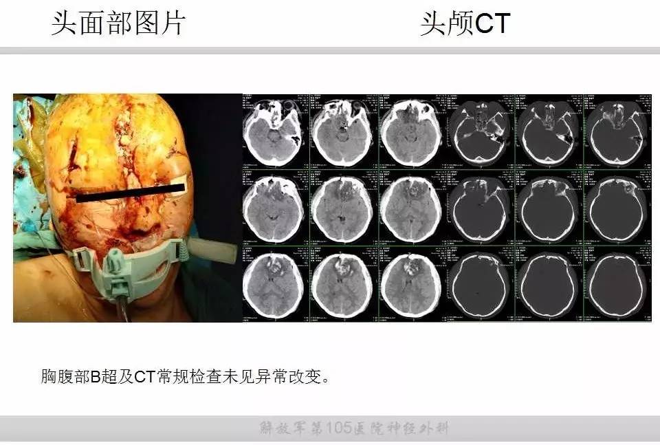 重型开放性颅脑损伤致脑脓肿一例丨颅脑创伤-神经重症