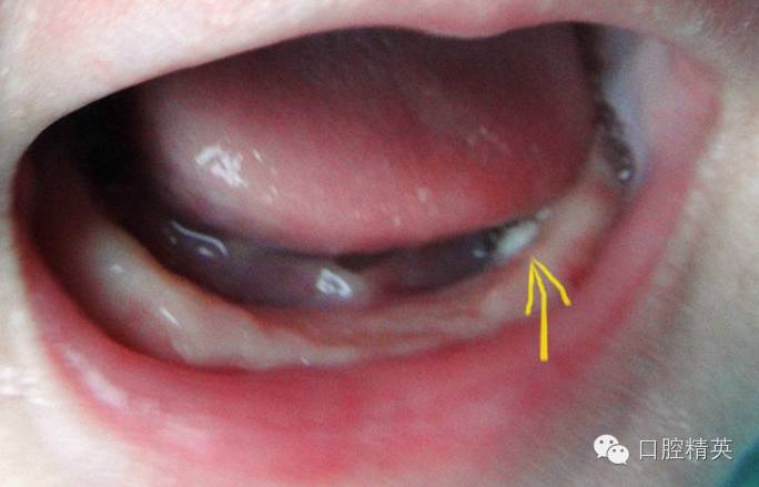 宝宝牙龈上的小白点是什么?