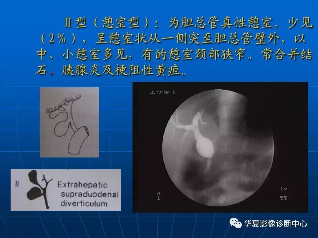 先天性胆管囊肿,该怎么分型?