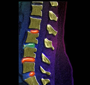 骨质疏松和腰椎间盘突出症都是腰腿痛分辨清楚才能对症治疗