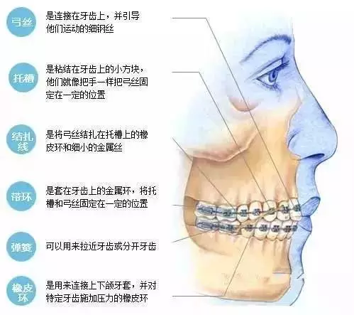 做牙套的原理_牙齿矫正的原理,原来牙套是这样移动的