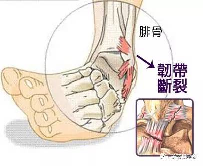 体育 正文  踝关节扭伤后59%遗留疼痛,肿胀,僵硬感和不稳等症状,这些