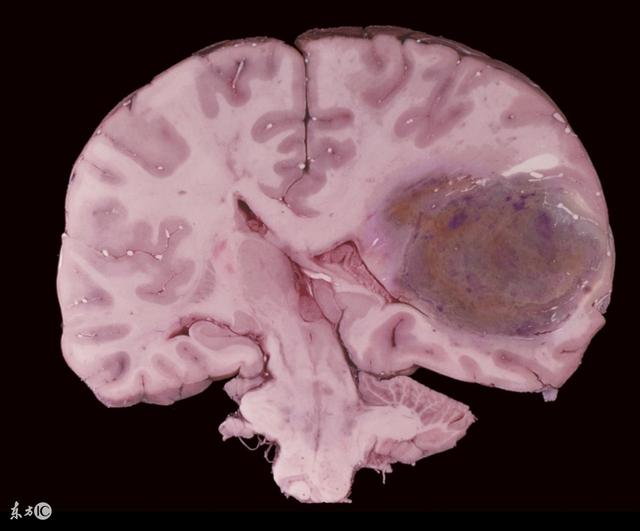 脑胶质瘤是中枢神经系统最常见的颅内恶性肿瘤,亦可以称为神经外胚层