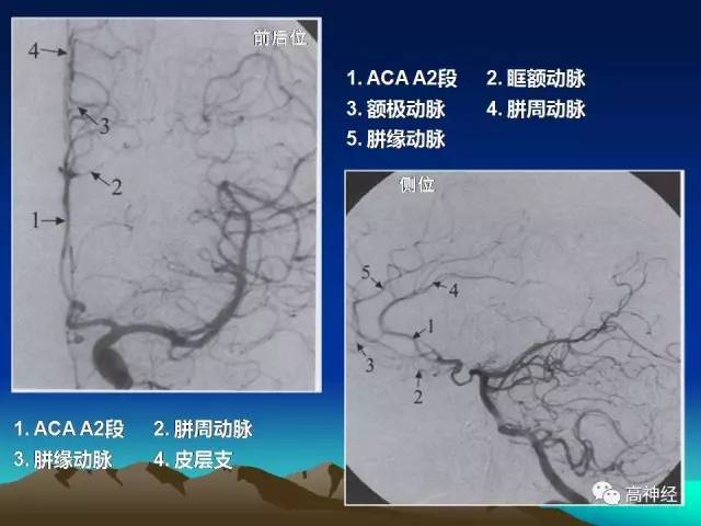 脑动脉解剖及分段