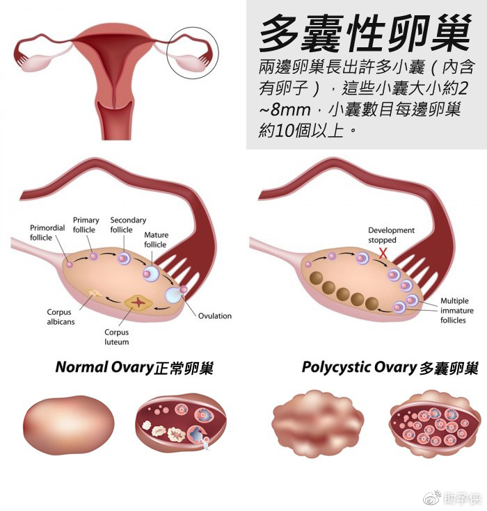 全面了解多囊卵巢综合症pcos