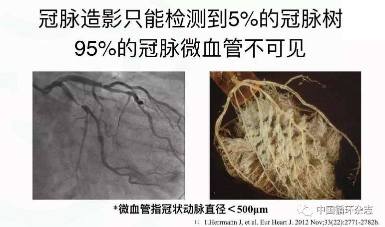 有胸痛但冠造正常,须警惕冠脉微循环异常