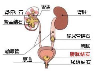 提前知道肾结石的早期症状,提前预防