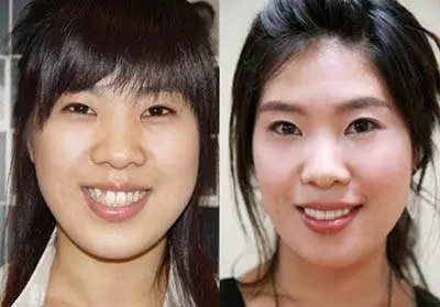 韩国明星--- 牙齿矫正前后对比
