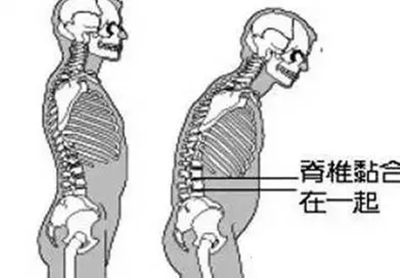 强直性脊柱炎继发骨质疏松患者的骨密度及骨代谢指标变化