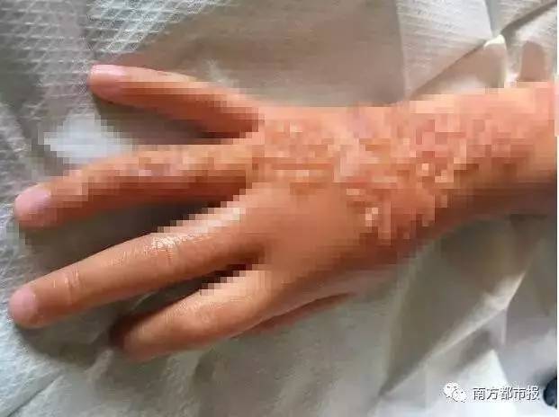 7岁女孩玩临时纹身出红疹起水泡留疤,整只手惨不忍睹!