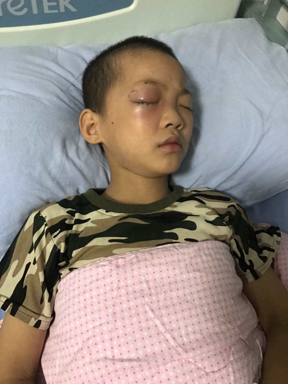 十岁小男孩被同学刺瞎眼睛,e.tent亿腾布线,用爱点亮心灯
