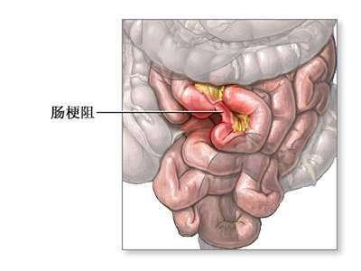 蛔虫性或粪块堵塞引起的肠梗阻,肠结核等炎症引起的不完全性肠梗阻等