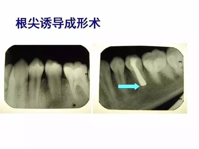 根尖诱导成形术