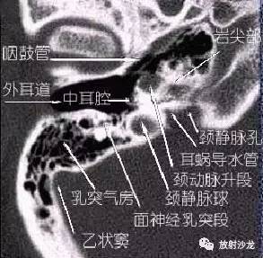 图文耳部颞骨轴位水平位hrct解剖上