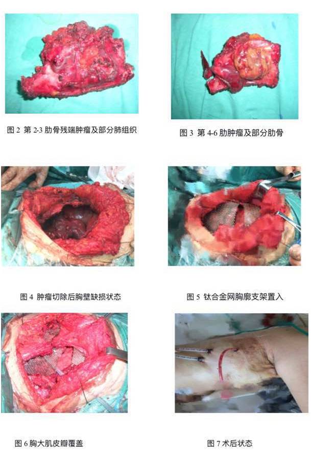 上海九院胸外科等多学科协作成功完成一例胸壁侵袭性纤维瘤复发手术