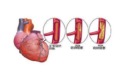 心脏搭脉停博是怎么意思_心脏搭桥是怎么回事(2)
