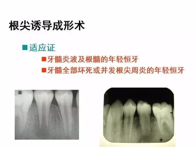 根尖诱导成形术