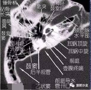 图文耳部颞骨轴位水平位hrct解剖上