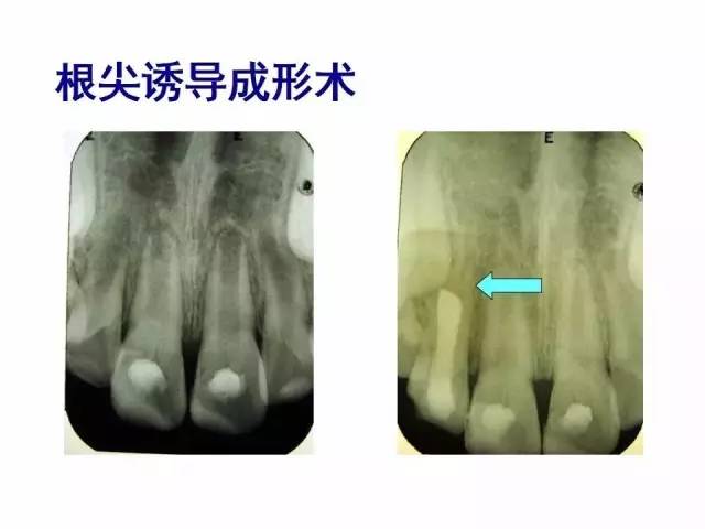 根尖诱导成形术