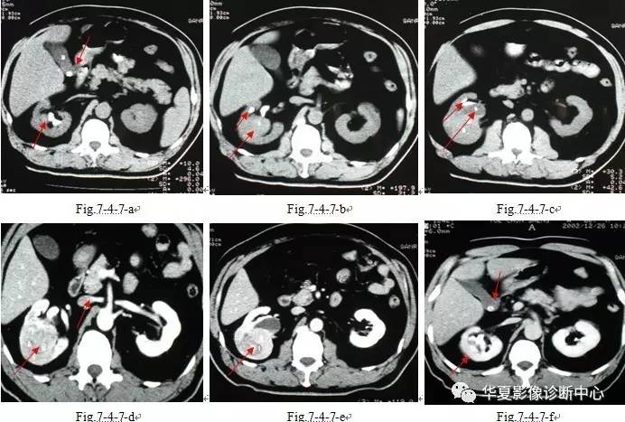 有图有真像-肾脏恶性肿瘤的ct表现