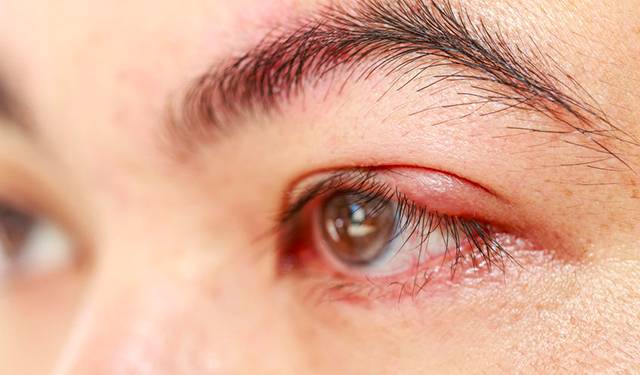 可能的疾病:眼睑炎(麦粒肿,针眼)